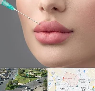 کلینیک ژل لب روسی در شاهین ویلا کرج