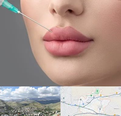 کلینیک ژل لب روسی در رودهن