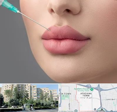 کلینیک ژل لب روسی در آپادانا