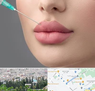 کلینیک ژل لب روسی در محلاتی شیراز