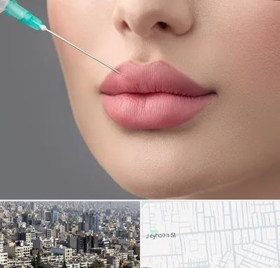 کلینیک ژل لب روسی در جیحون