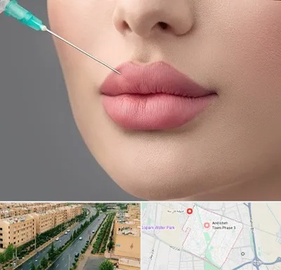 کلینیک ژل لب روسی در فاز سه اندیشه