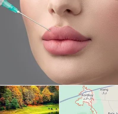 کلینیک ژل لب روسی در کردکوی