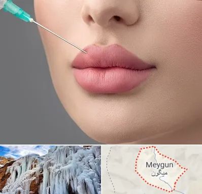 کلینیک ژل لب روسی در میگون