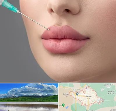 کلینیک ژل لب روسی در مرند