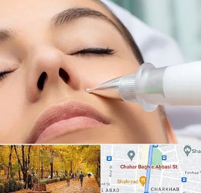 پلاسما جت بینی در چهارباغ اصفهان