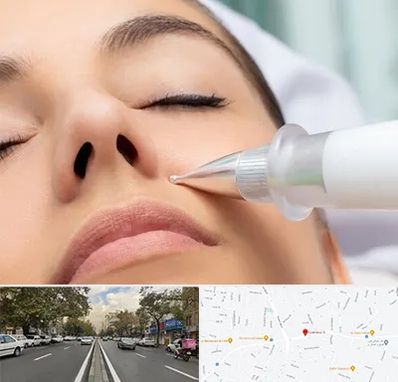 پلاسما جت بینی در دولت