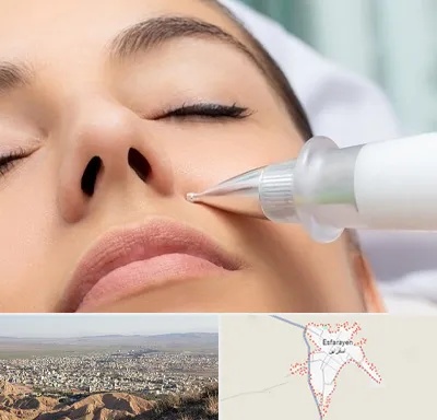پلاسما جت بینی در اسفراین
