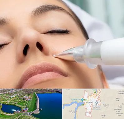 پلاسما جت بینی در مهاباد