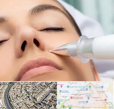 پلاسما جت بینی در شهرک غرب مشهد