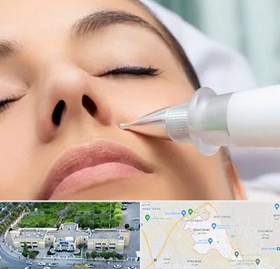 پلاسما جت بینی در نسیم شهر