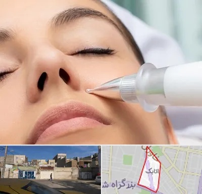 پلاسما جت بینی در اتابک