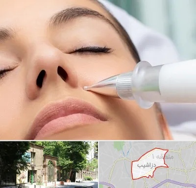 پلاسما جت بینی در دزاشیب