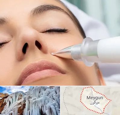 پلاسما جت بینی در میگون