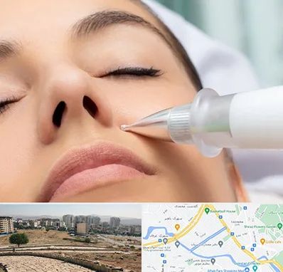 پلاسما جت بینی در کوی وحدت شیراز