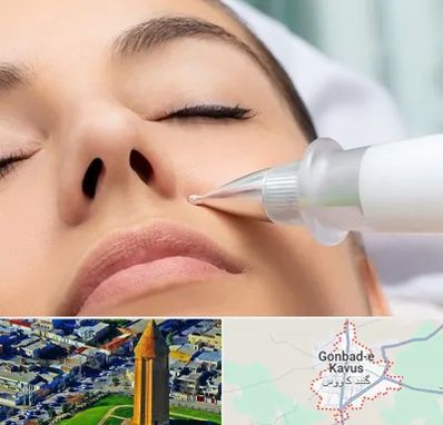 پلاسما جت بینی در گنبد کاووس