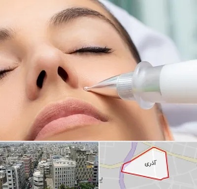 پلاسما جت بینی در آذری