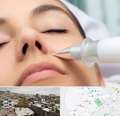 پلاسما جت بینی در شمیران نو