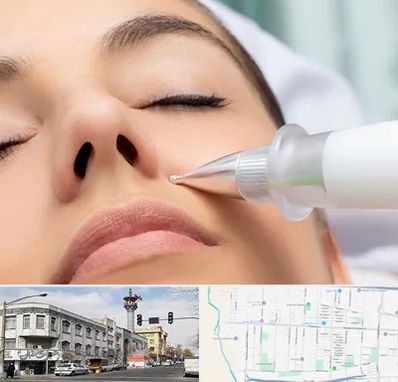 پلاسما جت بینی در 17شهریور