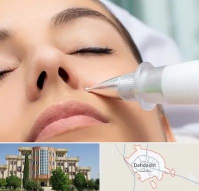 پلاسما جت بینی در دهدشت