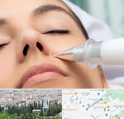 پلاسما جت بینی در محلاتی شیراز