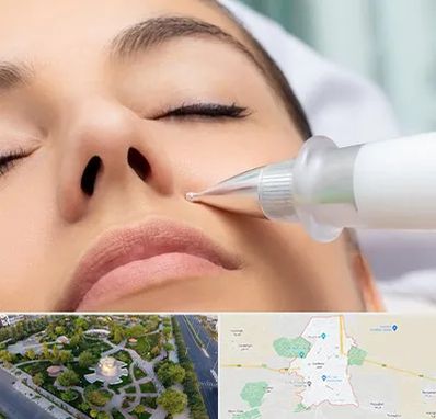 پلاسما جت بینی در کاشمر