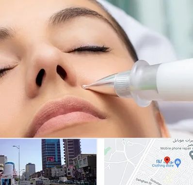 پلاسما جت بینی در چهارراه طالقانی کرج