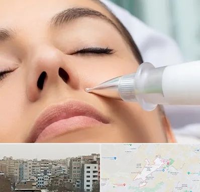 پلاسما جت بینی در محمد شهر کرج