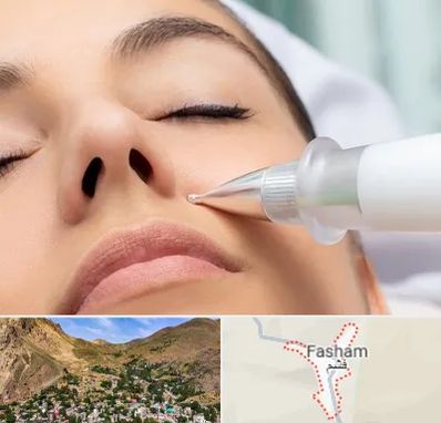 پلاسما جت بینی در فشم