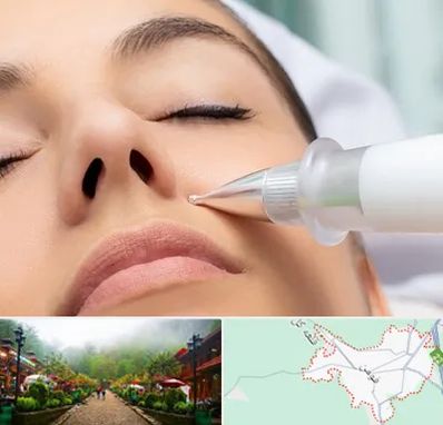 پلاسما جت بینی در فومن