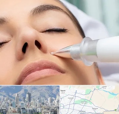 پلاسما جت بینی در شمال شرق تهران