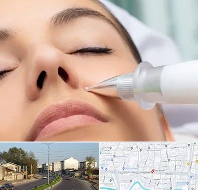 پلاسما جت بینی در ضیابری رشت