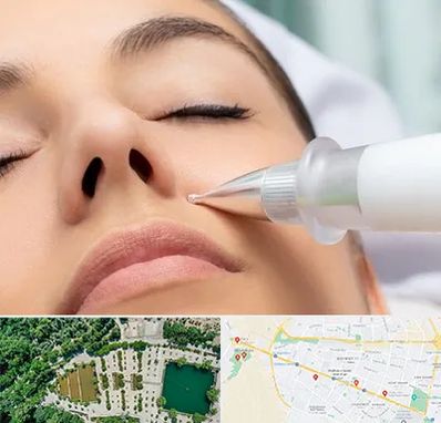 پلاسما جت بینی در وکیل آباد مشهد