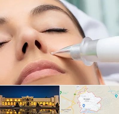 پلاسما جت بینی در برازجان