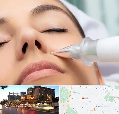 پلاسما جت بینی در بلوار سجاد مشهد