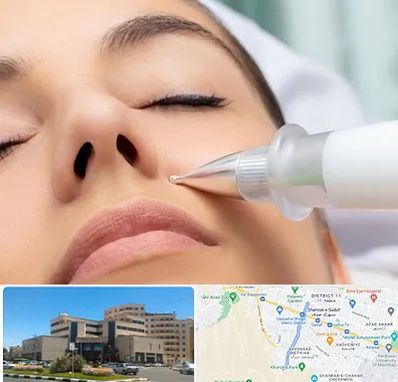 پلاسما جت بینی در صیاد شیرازی مشهد