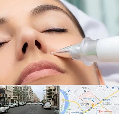 پلاسما جت بینی در زیتون کارمندی اهواز