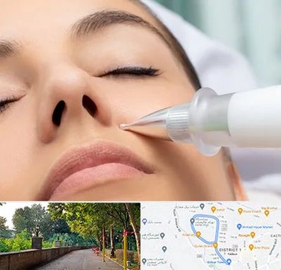 پلاسما جت بینی در فلکه گاز رشت