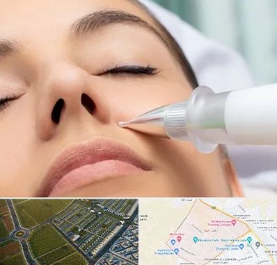 پلاسما جت بینی در الهیه مشهد