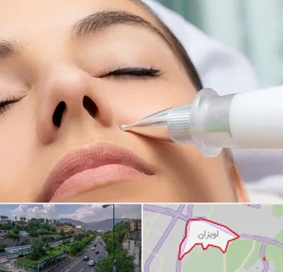 پلاسما جت بینی در لویزان
