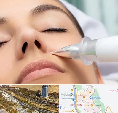 پلاسما جت بینی در خیابان نیایش شیراز