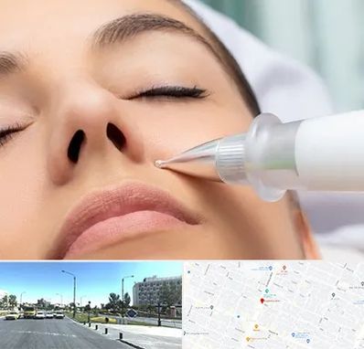 پلاسما جت بینی در بلوار کلاهدوز مشهد