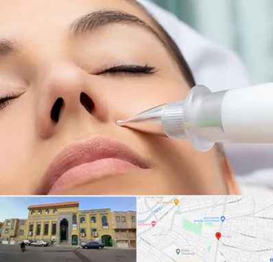 پلاسما جت بینی در زنبیل آباد قم