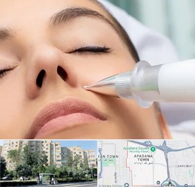 پلاسما جت بینی در آپادانا