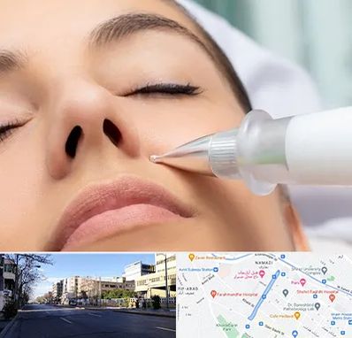 پلاسما جت بینی در خیابان ملاصدرا شیراز