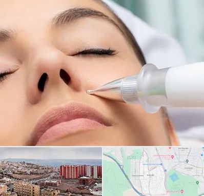 پلاسما جت بینی در سهند تبریز