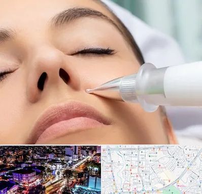 پلاسما جت بینی در منظریه رشت