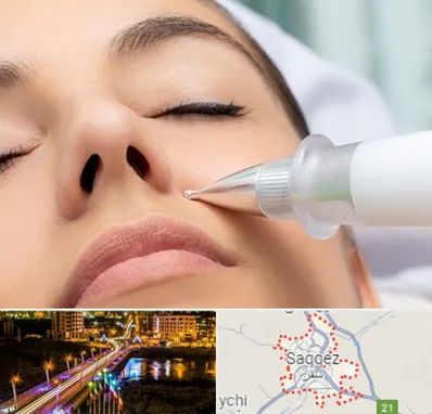 پلاسما جت بینی در سقز