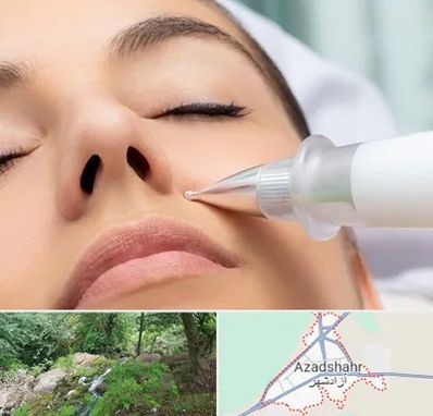 پلاسما جت بینی در آزادشهر