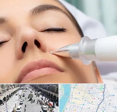 پلاسما جت بینی در نادری اهواز